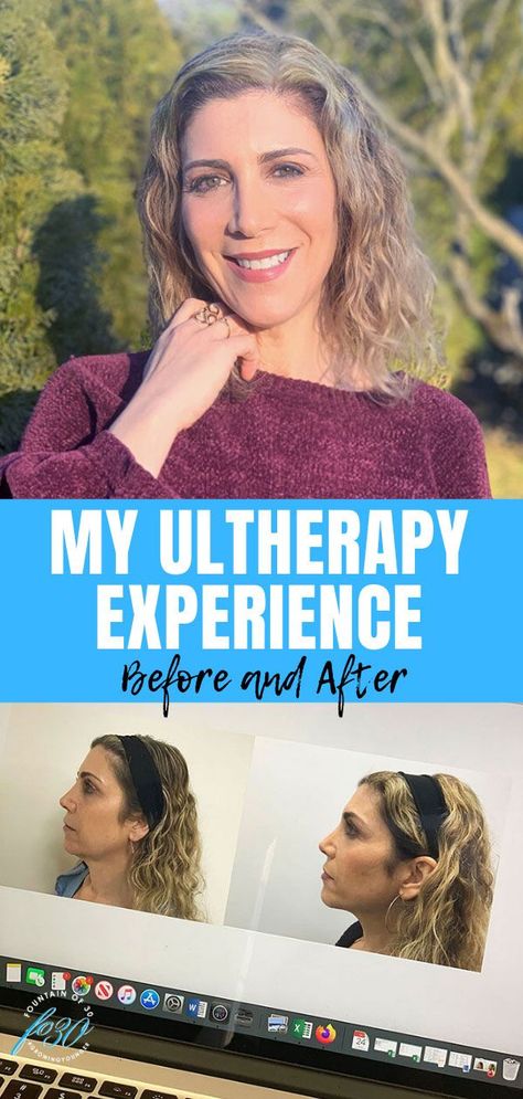 Read about my Ultherapy experience before and after. Ultherapy is the only FDA-cleared non-invasive treatments for lifting and tightening brow, neck and chin. #sponsored #ultherapy #antiaging #skincare #treatments Ultherapy Before And After Jowls, Neck Tightening Procedures, Neck Lift Before And After, Face Tightening Procedures, Ultherapy Before And After, Home Facial Treatments, Neck Tightening, Antiaging Skincare, Face Tightening