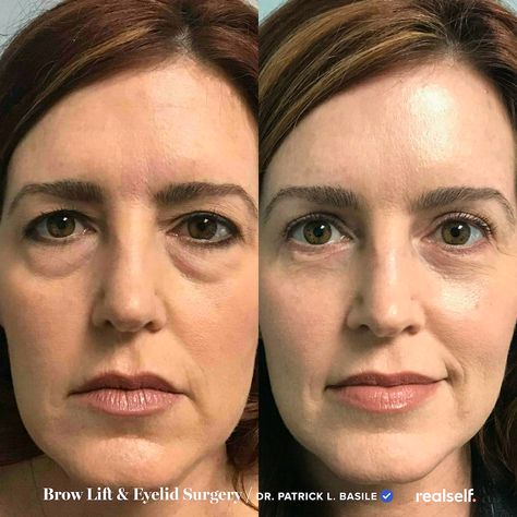 A brow lift, also known as a forehead lift, is a surgical procedure that raises the skin of the forehead to lift a sagging brow and smooth forehead lines and wrinkles. Hooded Eye Surgery, Eye Bag Surgery, Eye Lift Surgery, Endoscopic Brow Lift, Brow Lift Surgery, Neck Lift Surgery, Botox Brow Lift, Forehead Lift, Eyelid Lift