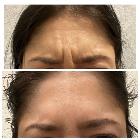 Cosmetic Surgery Before And After, Before And After Botox Pictures, Botox Before After, Vogue Pictures, Facial Before And After, Botox Results, Botox Facial, Botox And Fillers, Eyebrow Before And After