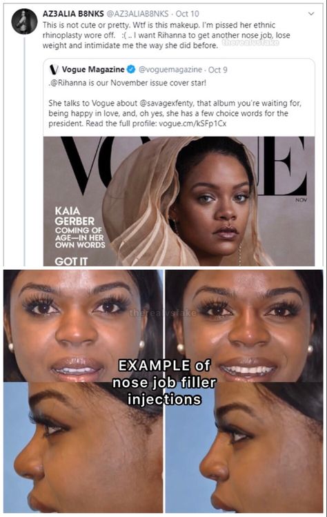 Nose Filler, Rihanna Kanye West, Hip Hop Rappers, Drake Rihanna, Ethnic Rhinoplasty, Nose Fillers, Rihanna Beyonce, Savage Fenty, Rubi Rose