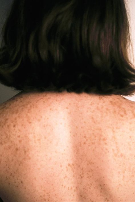 Have you ever spotted a tiny patch of lighter pigment on your skin and became quickly concerned? Us too. The good news is that while most of these white skin spots are related to sun damage, they’re harmless, but they can be aesthetically pesky. We found ourselves wondering why certain spots grow lighter than others on people of all skin tones. It seems it’s also somewhat of a mystery to experts, but here’s what they know. White Skin Spots, Body Imperfections, Sun Spots On Skin, Red Moles, Healthy Book, Coconut Health Benefits, Skin Spots, Baking Soda Shampoo, Black Patch