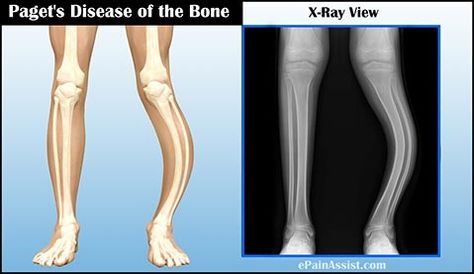 Medical Diseases, Pagets Disease, Gourmet Meat, Meat Store, Recipe For Success, Healthy Bones, Chronic Disease, The Bone, Disease