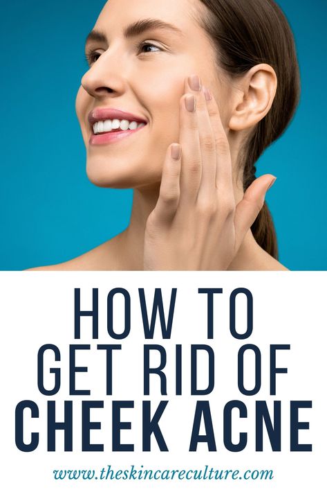 There are many ways you can get rid of cheek acne, however, the most important thing to do is to pay attention to good skincare practices, especially your cleansing and exfoliating habits.   Therefore, in this article, we will discuss everything you need to know about what causes acne on the cheeks, does drinking water really help acne, and how to get rid of cheek acne. How To Clear Cheek Acne, Cheek Acne Cause, Cheek Breakouts, Cheek Acne, Acne Causing Foods, Face Mapping Acne, Good Skincare, Bad Acne, Face Mapping