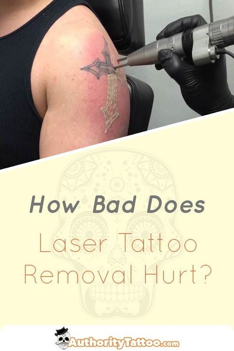 You may want to get a tattoo removed but you're worried about how much the process might hurt. We reveal all about laser tattoo removal pain in this article. Make Temporary Tattoo, Tattoo Removal Cost, Bolt Tattoo, Full Leg Tattoos, Full Tattoo, Cloud Tattoo, Healing Tattoo, Bad Tattoos, Skin Spots