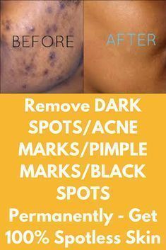 How to get rid of dark spot overnight with natural remedies Acne Dark Spots, Dark Spots On Face, Home Remedies For Acne, Dark Spots On Skin, Acne Scar Removal, Spots On Face, Pimple Marks, Homemade Beauty, Cystic Acne