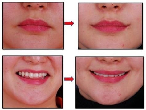 Aone, on its blog, explains that the surgery can help people with downturned mouth corners who naturally look “angry, stern, and aged.” | Plastic Surgery That Forces You To Smile Uncontrollably Is All The Rage Among South Korean Women Downturned Mouth, Extreme Plastic Surgery, Excessive Underarm Sweating, Resting Face, Best Lip Gloss, Botox Injections, Reconstructive Surgery, Nude Lips, Body Modification