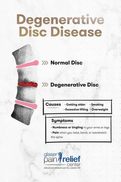 Most people have some degree of disc degeneration starting between the ages of 40 to 60. Not everyone will experience symptoms of pain at that point, however.  Here are the symptoms of degenerative disc disease to look out for☝ Degenerate Disc Disease, Spinal Fusion Surgery, Spine Problems, Lumbar Disc, Degenerative Disease, Spine Health, Leg Pain, Bone Health, Medical Care