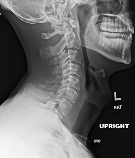 Cervical spine: lateral view Cervical Spine Exercises, Neck Anatomy, Whiplash Injury, Neck Traction, Neck Problems, Neck Surgery, Spinal Surgery, Cervical Traction, Traction Device