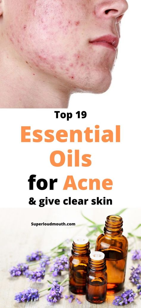 Essential Oils For Acne, Oils For Acne, Face Mapping Acne, Essential Oils For Face, Acne Overnight, Diy Acne, Natural Acne Remedies, Natural Acne, Baking Soda Shampoo