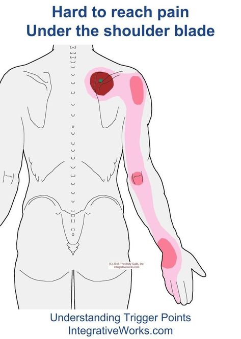 Trigger Points – Vague pain in the back of the shoulder and arm | | Integrative Works Psoas Release, Tight Hip Flexors, Trigger Point Therapy, Psoas Muscle, Upper Back Pain, Ju Jitsu, Neck And Shoulder Pain, Joints Pain Relief, Trigger Points