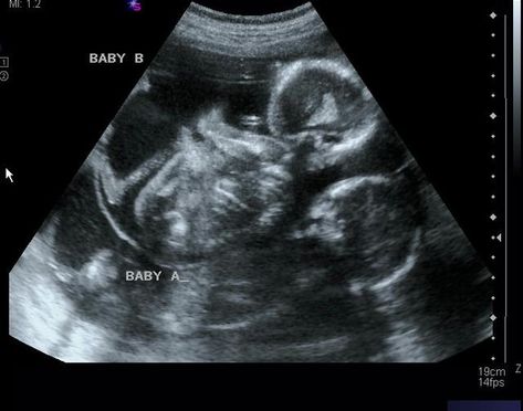 Baby Gender Ultrasound, Twins Ultrasound, Baby Ultrasound Pictures, Sonogram Pictures, Bump Pictures, Baby Ultrasound, Ultrasound Pictures, Cute Babies Photography, Twin Pregnancy