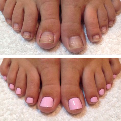 Manicure Before And After, Pedicure Before And After, Pedicure Tradicional, School Portfolio, Toes Nails, Summer Pins, Oil Field, Acrylic Toes, Acrylic Toe Nails