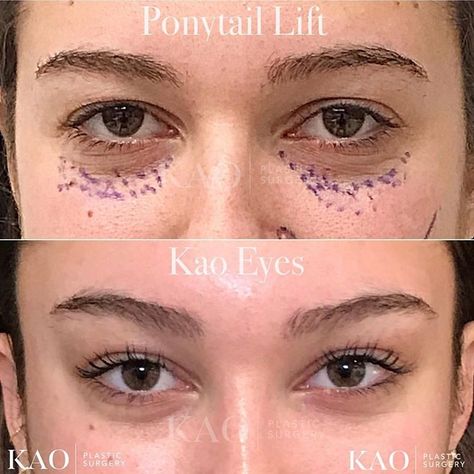 cat eye surgery | pony tail lift | plastic surgery | cirugía cosmética | blepharoplasty | Eye Lift Surgery, Kylie Jenner Eyes, Face Plastic Surgery, Easy Cat Eye, Cat Eye Tutorial, Face Fillers, Plastic Surgery Gone Wrong, Eye Tricks, Facial Fillers