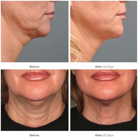 Ultherapy Before And After, Hide Wrinkles, Non Surgical Facelift, Skin Peel, Kathie Lee Gifford, Anti Aging Wrinkles, Skin Resurfacing, Gobble Gobble, Laser Skin