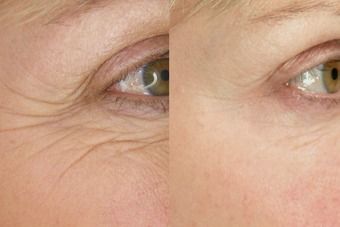 Home Remedies For Wrinkles, Homemade Wrinkle Cream, Womens Health Magazine, Melt Cosmetics, Under Eye Wrinkles, Health Trends, Eye Wrinkle, Workout Motivation Women, Anti Aging Tips