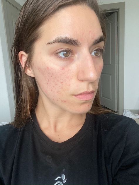 Fading Acne Marks, Fade Acne Marks Fast, Red Marks On Skin, How To Fade Acne Marks, Red Acne Marks, Cheek Acne, Redness Pimple, Fade Acne Marks, Acne Scaring