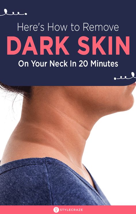 How To Remove Dry And Dark Skin On Your Neck In 20 Minutes: The darkening of the skin on the neck could be due to a lot of reasons. Sun exposure could be one of the main reasons, but it could also be due to a specific health concern such as insulin resistance. For those of us who have just been negligent with sunscreens, here are some easy remedies to gradually lighten those patches on your neck. #Remedies #HomeRemedies #DarkNeck #SkinCare Dark Skin Around Neck, Dark Neck Remedies, Skin Lightening Diy, Dark Neck, Blind Pimple, Skin Darkening, Pimples Under The Skin, Armpit Fat, Tan Removal