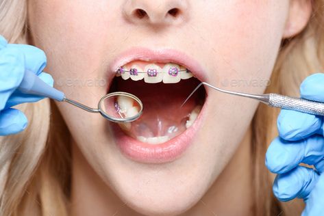 Cropped shot of dentist in latex gloves using a mouth mirror and periodontal probe on woman with by LightFieldStudios. Cropped shot of dentist in latex gloves using a mouth mirror and periodontal probe on woman with #Sponsored #latex, #gloves, #dentist, #Cropped Braces Food, Free Dental Implants, Mouth Mirror, Tooth Pulled, Clear Braces, Orthodontics Braces, Teeth Braces, First Tooth, Dental Implants