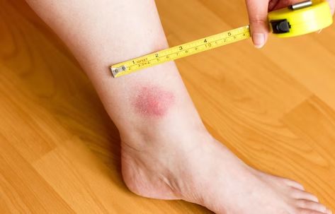 Identifying Insect Bites: Pictures Of 11 Common Bug Bites Insect Bite, What Different Bug Bites Look Like, Bug Bite, Tick Bites On Humans, Spider Bites Remedies, Insect Bites Identification, Different Bug Bites, Tick Bite Rash, Bug Bites Identifying