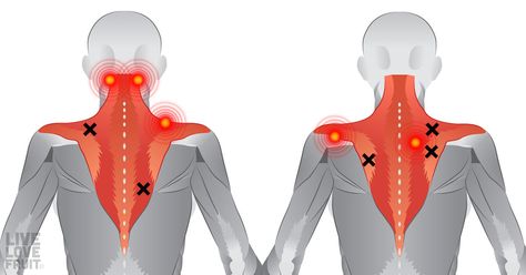 back muscles illustrating common problem areas and trigger point pain referral areas Stiff Neck Exercises, Neck And Shoulder Stretches, Hygiene Hacks, Neck Pain Exercises, Neck And Shoulder Exercises, Shoulder Stretches, Tight Shoulders, Lower Back Pain Exercises, Neck Exercises