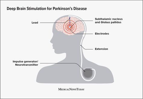 Deep brain stimulation (DBS) for Parkinson’s: What to expect Deep Brain Stimulation, P Words, Brain Stimulation, Mri Scan, Disease Symptoms, Muscle Contraction, Vision Problems, Nerve Cell, Neurological Disorders