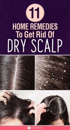 Get Rid Of Dry Scalp, Remedies For Dry Scalp, Itchy Scalp Remedy, Dry Scalp Remedy, Itchy Flaky Scalp, Dry Flaky Scalp, Home Remedies For Dandruff, Scalp Moisturizer, Dandruff Remedy