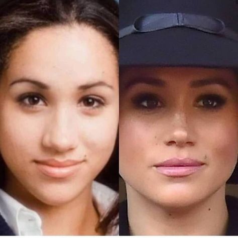 Megan Markle Nose, Meghan Markle Nose Job, Kpop Plastic Surgery, Jaw Reduction Surgery, Bad Celebrity Plastic Surgery, Nose Plastic Surgery, V Line Surgery, Plastic Surgery Fail, Korean Plastic Surgery