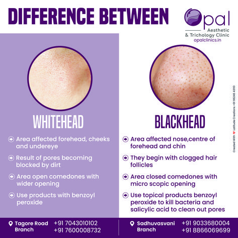 🔍✨ Spot the difference between blackheads and whiteheads with Opal Clinic! 🌟 Knowing the difference helps you choose the right treatments and products for clear, beautiful skin! 💁‍♀️💖 Like, Share and Follow us for more skincare tips! Opal Clinic Rajkot, Gujarat #SkinCareMagic #BlackheadRemoval #WhiteheadTreatment #OpalClinic #ClearSkin #SkinCareSolutions #HealthySkin #BeautyCare #Dermatology #SkinCare #Blackheads #Whiteheads Skincare Blackheads, Blackheads And Whiteheads, Learn Yoga Poses, Cleaning Your Ears, Learn Makeup, Spot The Difference, Dermatological Skin Care, Cleanse Recipes, Get Rid Of Blackheads