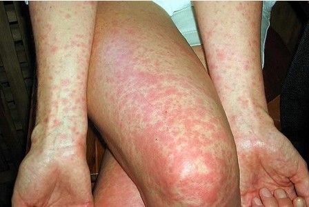 Parents should once again be on the look out for scarlet fever signs and symptoms following an increase in outbreaks across the country.  Scarlet fever is mainly a childhood disease and most common... Home Remedies For Skin, Natural Antibiotics, Bacterial Infection, Skin Remedies, Signs And Symptoms, Natural Home Remedies, Herbal Remedies, Home Remedies, Scarlet