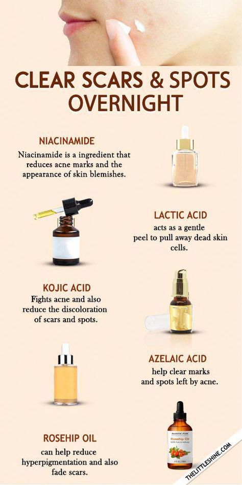 Dark Spots On Face, Cold Sores Remedies, Natural Sleep Remedies, Spots On Face, Baking Soda Shampoo, Natural Cough Remedies, Makijaż Smokey Eye, Skin Blemishes, How To Get Rid Of Acne