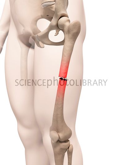 Femur Fracture, Gastrocnemius Muscle, Femur Bone, Types Of Bones, Anatomy Bones, Bone Fracture, Complementary Medicine, Alternative Treatments, Medical Illustration