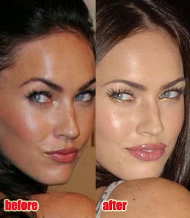 Megan Fox Lips, Under Eye Creases, Under Eye Fillers, Rhinoplasty Surgery, Facial Plastic Surgery, Facial Plastic, Lip Injections, Nose Job, Cosmetic Procedures