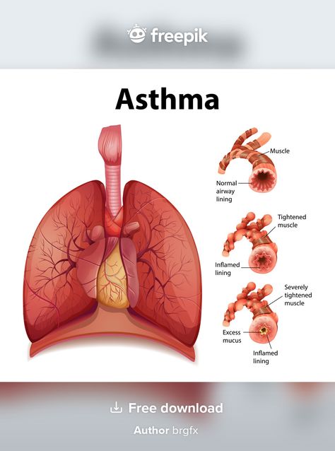 Throbbing Headache, How To Help Nausea, Severe Asthma, Healthy Lungs, Chronic Obstructive Pulmonary Disease, Asthma Symptoms, Healthy Morning Routine, Pulmonary Disease, Asthma Attacks