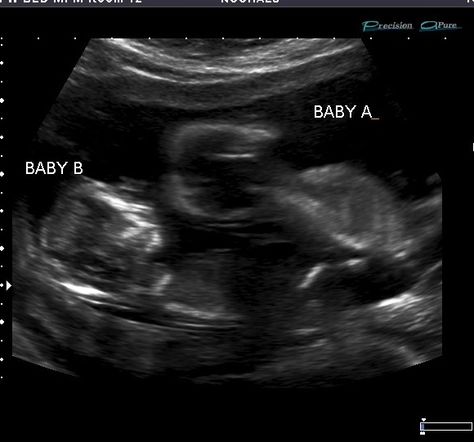 My Babies 3 Month Ultrasound, Usg Pregnancy Photography, Usg Pregnancy, Twins Ultrasound, Baby Ultrasound Pictures, 2 Months Pregnant, 12 Weeks Pregnant, Cute Relationship Pictures, 4d Ultrasound