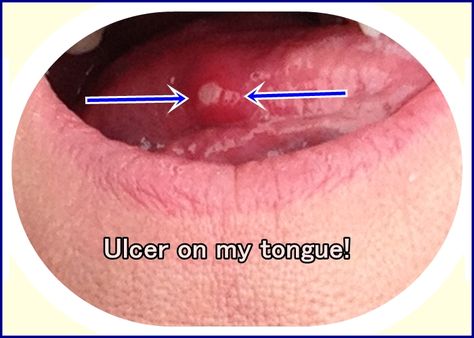 Home Remedies for Mouth Ulcers Sore Tongue Remedy, Tongue Ulcer Remedies, Sore On Tongue Remedy, Mouth Ulcer Remedies, Mouth Blister Remedy, Ulcers In Mouth, Sore In Mouth Remedies, Canker Sore On Tongue, Types Of Mouth