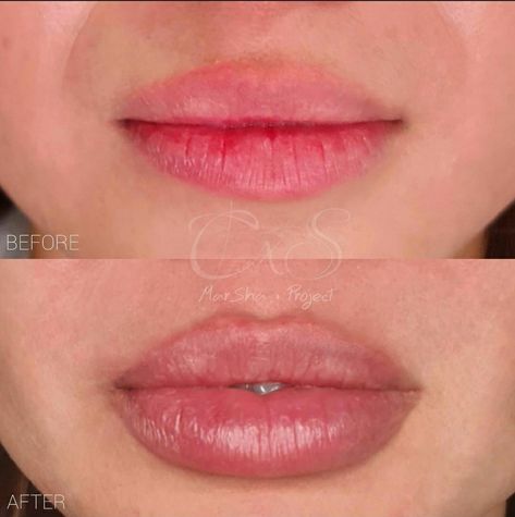 🔑 A lip filler technique where the lips are filled with a small gap in the center where the top and bottom lip meet that looks like a “keyhole”. 👄 Lip enhancement procedure using HA fillers which aims to boost lip volume, enhance lip shape, and smooth vertical lip lines (perioral rhytids). 💉 Lip fillers is a minimally invasive cosmetic procedure which involves injecting HA fillers into the lip for plumper and smoother effect with fast recovery time than surgery and  last for 6 to 12 mos. Heavy Lower Lip, Keyhole Lips, Lip Filler Technique, Lip Augmentation, Lip Filler, Lip Enhancement, Lower Lip, Bottom Lip, Lip Shapes