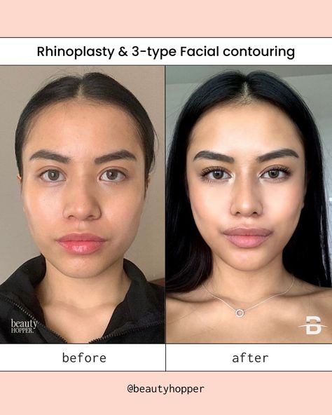 Before and after results that look natural✨😍 This beautiful patient wanted a more slender and defined nose, along with a reduction in the size and width of her cheeks and jawline to achieve a more sculpted v-line shaped look🩷 For price inquiries, please contact us: 💌: contact@beautyhopper.com 📲: WhatsApp: +(82)1098587703 Start planning your plastic surgery trip to Korea with @beautyhopper 🛩 OUR SERVICES INCLUDE: 🩺 Doctor selection 🗣 Translation 🚕 Transportation 💊 Medication coverage 📝 L... Defined Nose, Kpop Plastic Surgery, Jaw Reduction Surgery, Face Plastic Surgery, V Line Surgery, Trip To Korea, Plastic Surgery Korea, Plastic Surgery Fail, V Line Face