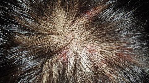 Scabs On Scalp How To Get Rid Of, Scalp Sores How To Heal, Scalp Psorasischic, Seborrheic Dermitis On Scalp, Scalp Pimples, Heat Bumps, Scalp Scabs, Bump On Head, Scalp Bumps