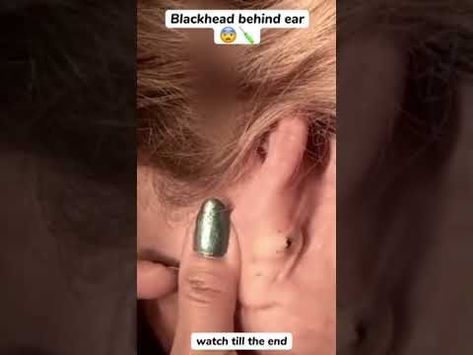 Blackhead Behind Ear #oddlysatisfying #sick #blackhead #pimplepopper #satisfying #cyst #wow #acne Ear Pimple, Big Pimple, Cystic Pimple, Dilated Pores, Cystic Acne Remedies, Blackhead Remover Diy, Blind Pimple, How To Pop Ears, Zits Popping