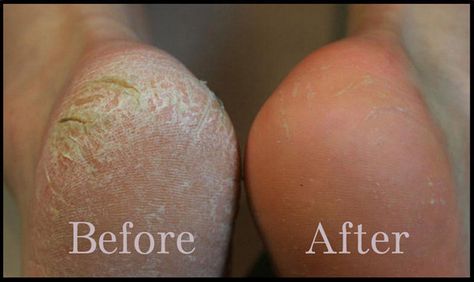 If you've got tons of dry, scaly skin on the bottoms of your feet, try a Baby Foot exfoliating mask. Dry Cracked Heels, Scaly Skin, Exfoliating Mask, Foot Soak, Cracked Heels, Callus Removal, Skin Problems, Dead Skin, Diy Beauty