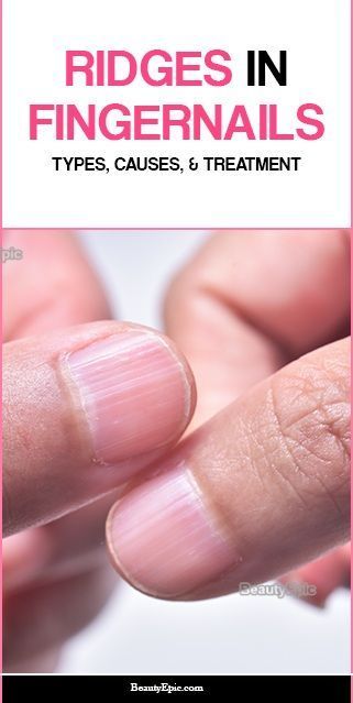 Fingernail Ridges, Fingernail Health, Natural Hair Removal Remedies, Nail Remedies, Nail Ridges, Fingernail Fungus, Nail Problems, Nail Fungus Remedy, Tongue Health