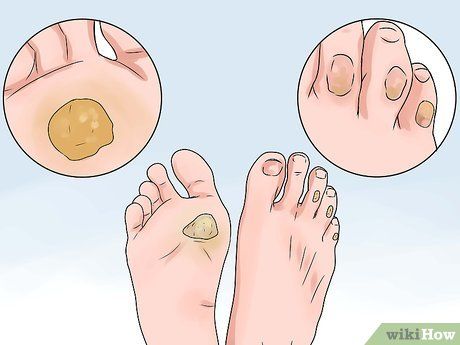 How to Treat a Corn or Callus (with Pictures) - wikiHow Callus Remover Diy, Get Rid Of Corns, Corn Removal, Haircut For Face Shape, How To Make Corn, When To Plant Vegetables, Nail Problems, Fungal Nail, Cracked Heels