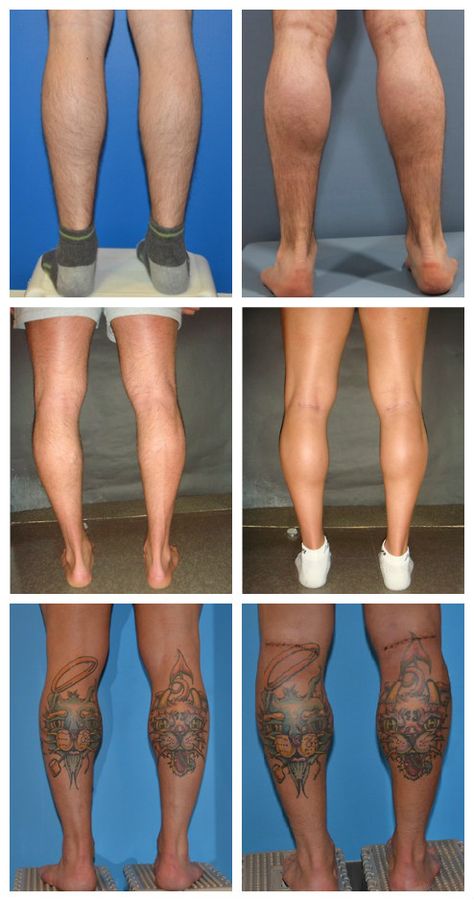 Calf Implants (Augmentation): Cost, Before and After, Risks, and Recovery Cosmetic Procedures, Quick Saves