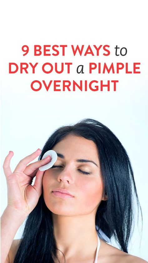 9 Best Ways to Dry Out a Pimple Overnight #naturalskincare #skincareproducts #Australianskincare #AqiskinCare #australianmade Dry Out Pimples, Home Remedies For Pimples, Pimples Overnight, Acne Overnight, Pimples Remedies, Skin Care Routine For 20s, Overnight Beauty, How To Get Rid Of Pimples, Remove Acne