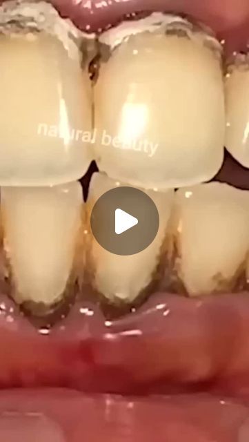 Healthy Tips on Instagram: "Remove Tartar and Yellowness From Your Teeth #teethwhitening #yellowteeth #remedy #naturalremedies" How To Remove Tartar From Teeth, Remove Tartar From Teeth At Home, Teeth Whitening Before And After, Yellow Teeth Remedy, Instant White Teeth, Teeth Makeover, Whiten Teeth At Home, After Wisdom Teeth Removal, Natural Teeth Whitening Diy