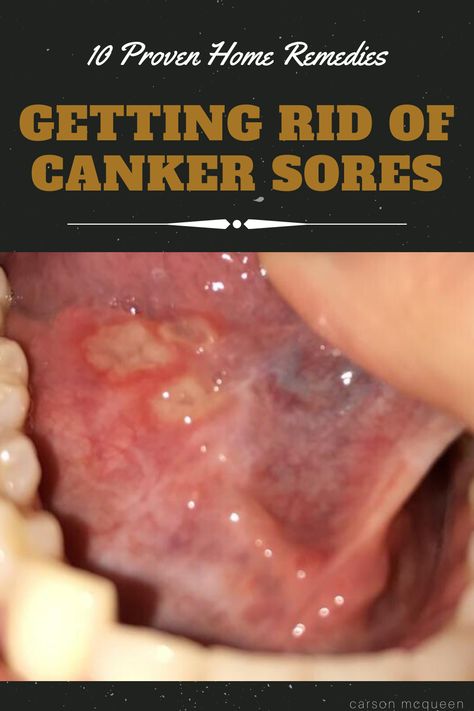 Find out how to get rid of canker sores using home remedies found in your kitchen! Say goodbye to these persistent wounds for good!  #cankersore #cankersoreremedy #howtogetridofcankersore #cankersoreremedytongue ##cankersoreremedymouth #howtogetridofcankersorefast How To Get Rid Of A Canker Sore Fast, Essential Oils Canker Sore, Canker Sore On Tongue, Cold Sore Remedy Overnight, Canker Sore Relief, Ulcer Remedies Mouth, Canker Sore Remedy, Tongue Sores, Mouth Rinse