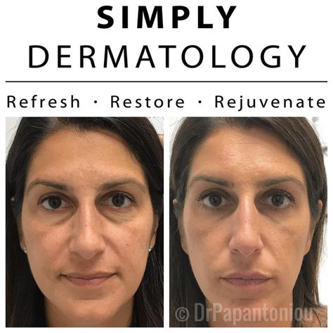 Under-eye hollows and shadows can make us look pretty tired, this is a before and after of Restylane injections. She now looks well rested, and still very natural 🖤 Call today to secure your appointment! 6313777245 . . #drpapantoniou #simplydermatology #skincare #simplycollection #fillers #naturalskincare #BOLI #bestoflongisland #beforeandafter #finelines #wrinkles #cosmeticdermatology #medicaldermatology #expertinjector #dermalfillers #botox #longislandexpertinjector #nyexpertinjector Eye Hollows, Under Eye Hollows, Cosmetic Dermatology, Well Rested, Dermal Fillers, Dermatology, How To Look Pretty, Natural Skin Care, Wrinkles