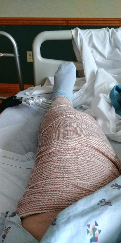 my "bee's knee" just got replaced yesterday. looking forward to living life again. Hospital Room Snapchat Stories, Hospital Admit Hand Pics, Iphone Screen Repair, Plant Styling, Joker Hd Wallpaper, Video Call With Boyfriend Screen Photo, Knee Wraps, Leg Injury, Army Pics