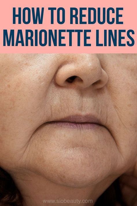 Lines Around Mouth, Mouth Wrinkles, Marionette Lines, Wrinkle Remedies, Face Yoga Exercises, Face Yoga Facial Exercises, Face Exercises, Skin Care Wrinkles, Saggy Skin