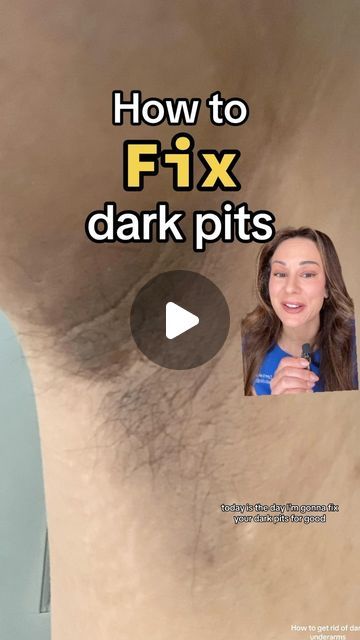 Lindsey Zubritsky, MD, FAAD on Instagram: "How to fix your dark pits: part ✌️ 

Step 1) address the underlying cause
Step 2) fix the darkness

Caution: several of these products mentioned including exfoliating acids (AHAs and BHAs) so use with caution. Start with a lower % and use only a few times a week. Increase as tolerated and decrease if irritation occurs.

As always, it’s best to see a dermatologist for guidance if you have a rash or OTC products don’t work

What’s worked to lighten your dark underarms? Lemme know in the comments below ⬇️" Underarm Darkness Products, Lightening Underarms, Regular Skin Care Routine, Dark Armpits, Skin Lightener, Serious Skin Care, Dark Underarms, Health Hacks, Best Skin Care Routine